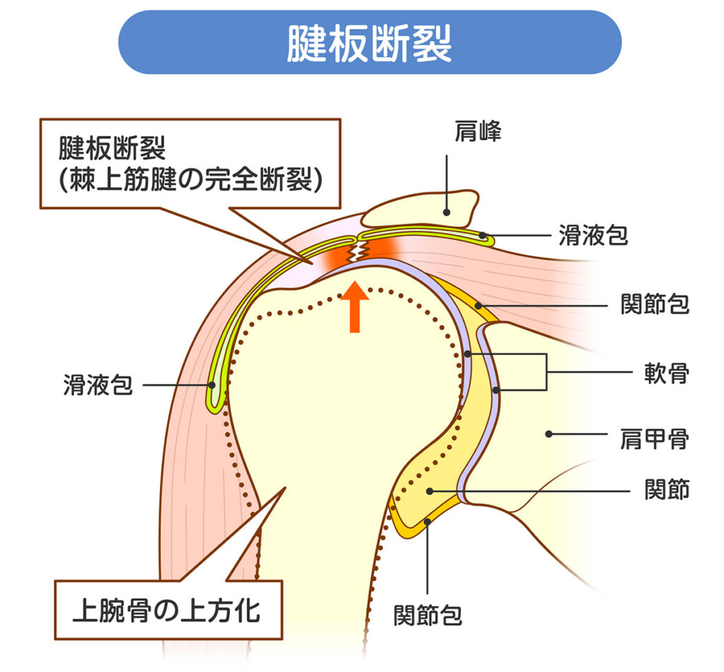 肩腱板断裂とは?肩の痛みと腕が上がらない原因 | ササモト整形外科